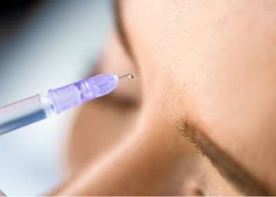 injection comblement botox montpellier